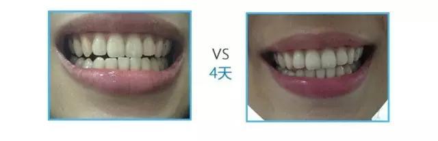 用了1年的健齿白,牙还这么黄,如何让我的笑容更有力量?